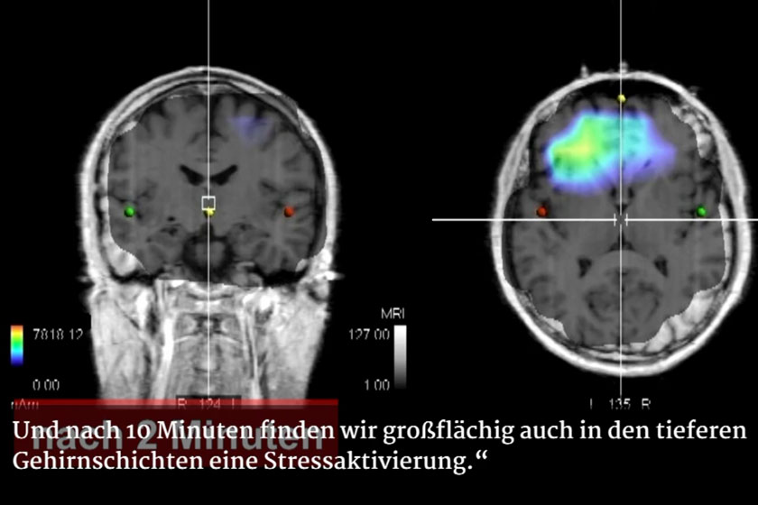 L'IRM montre en couleur les couches du cerveau d'une personne activées par les radiations.