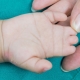 Eine missgebildete Hand eines Babys (Stummel-Finger).